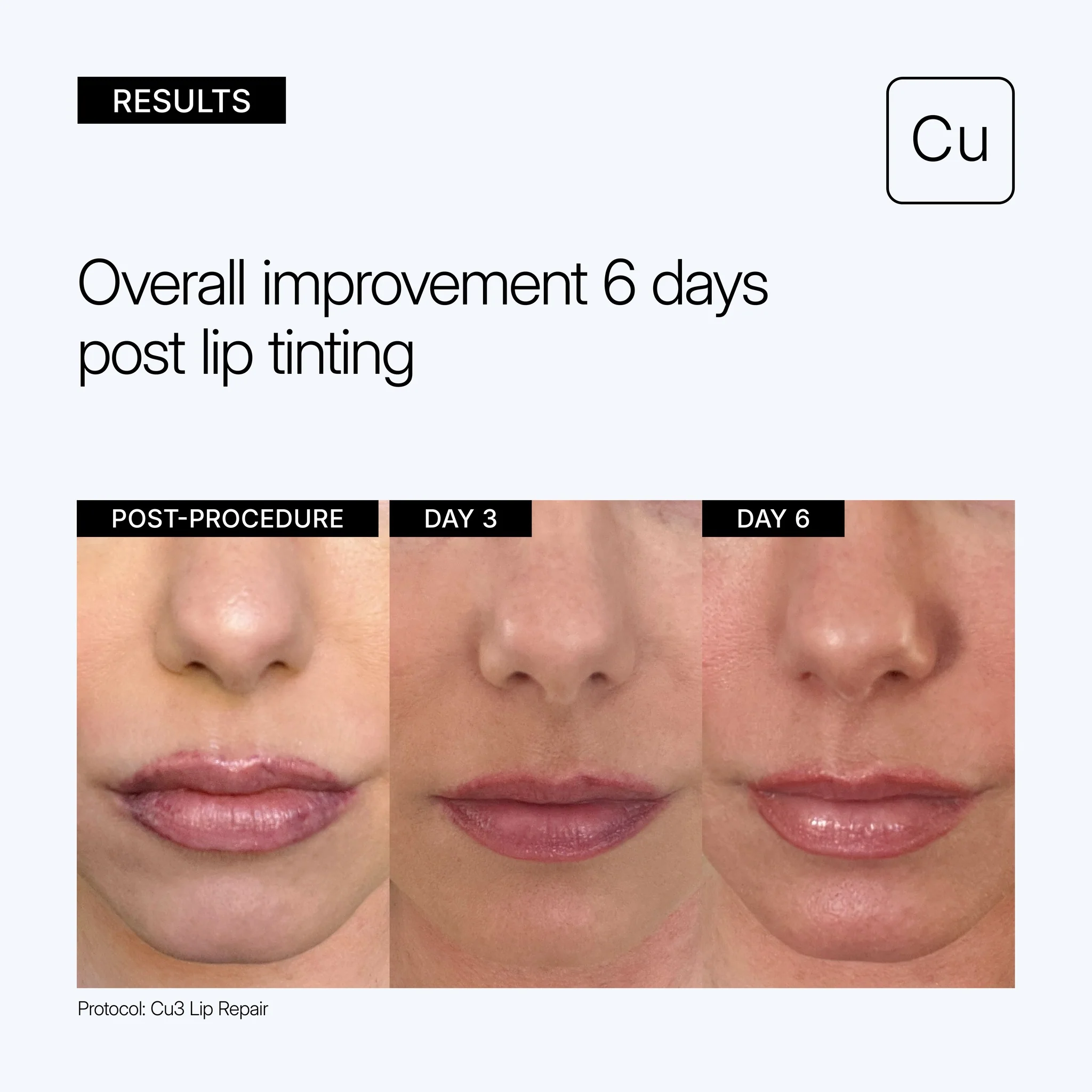 Cu3 Lip Repair - Image 3