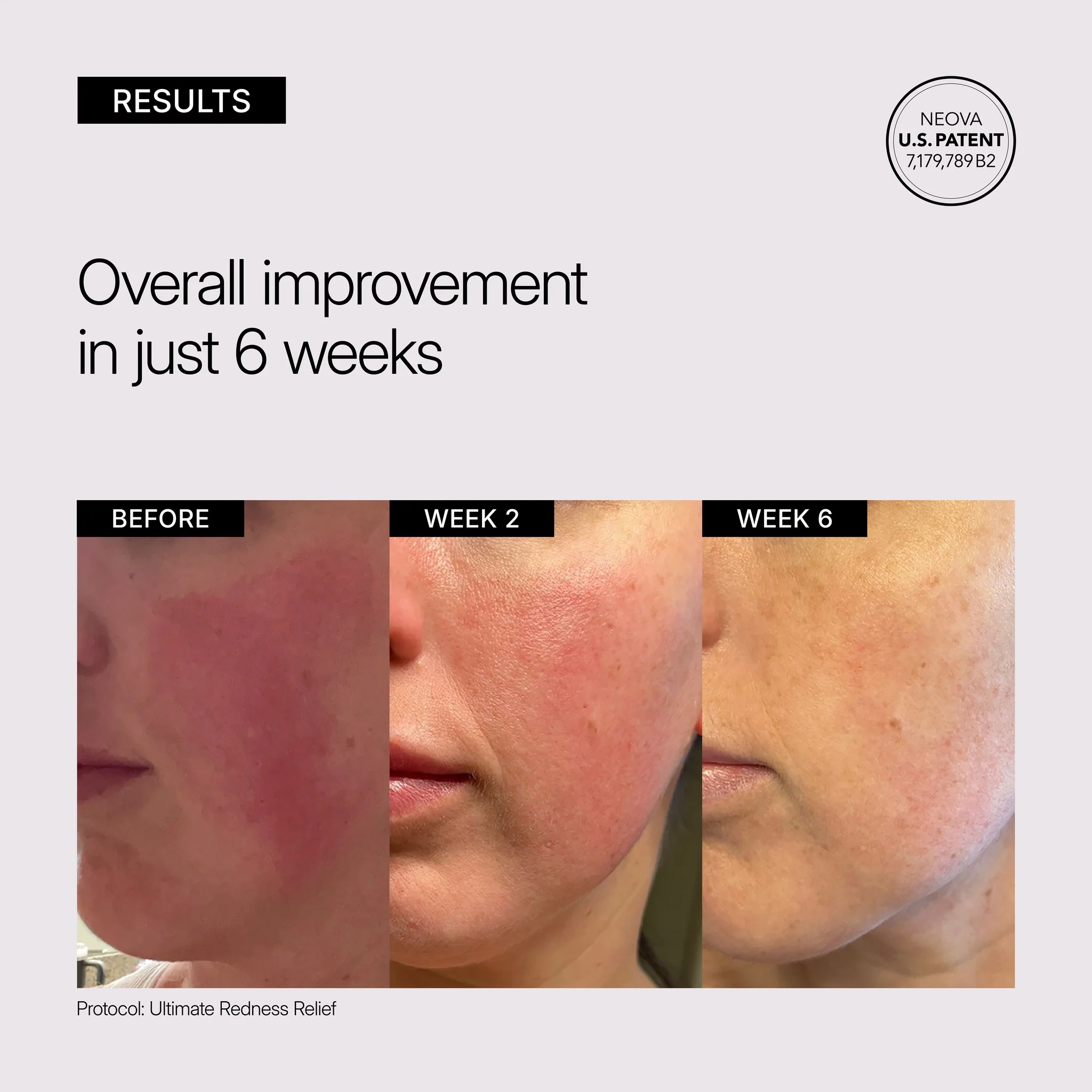 Ultimate Redness Relief - Image 4